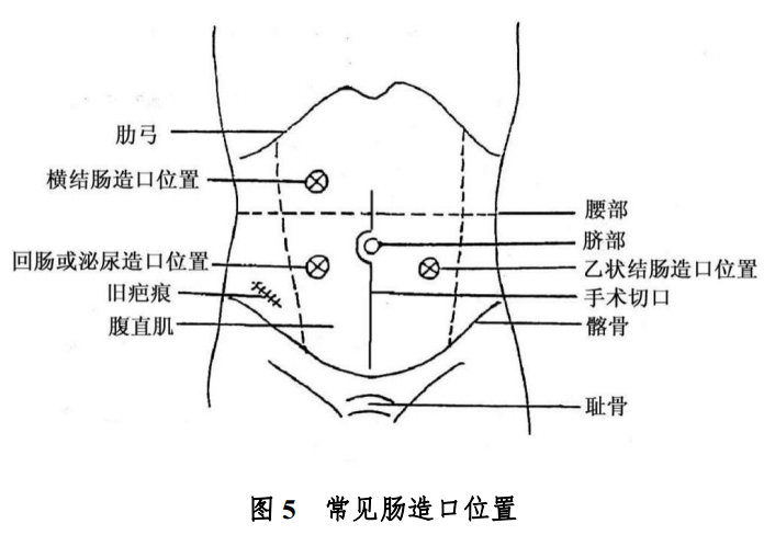 什么是放疗定位膜中国结直肠癌诊疗规范（2020）_https://www.jmylbn.com_新闻资讯_第20张