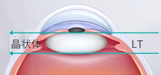 怎么测角膜直径【原创】生物测量参数︱屈光参数的详解_https://www.jmylbn.com_新闻资讯_第14张