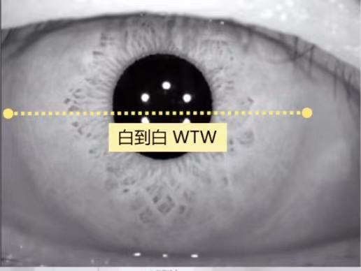 怎么测角膜直径【原创】生物测量参数︱屈光参数的详解_https://www.jmylbn.com_新闻资讯_第17张