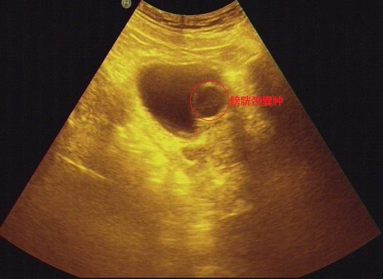 膀胱颈囊肿:一种罕见的膀胱颈良性病变_医学界-助力医生临床决策和