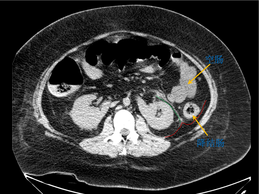 raus专栏|肾周间隙的层面与毗邻02