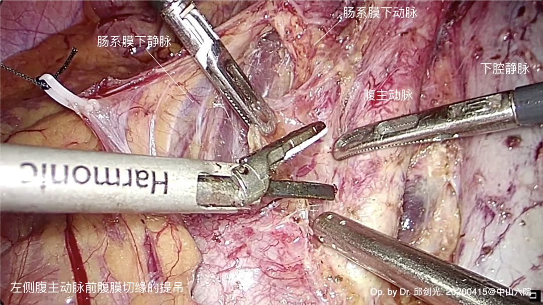 腹腔镜篇层面外科仰卧位右侧盆腔淋巴清扫加双侧腹膜后淋巴清扫术