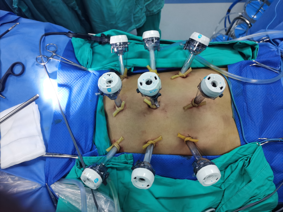 腹腔镜篇层面外科仰卧位右侧盆腔淋巴清扫加双侧腹膜后淋巴清扫术