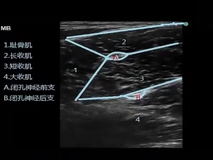 經尿道膀胱腫瘤電切術中閉孔神經反射的預防_醫學界-助力醫生臨床決策