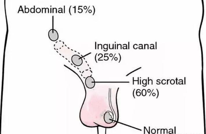 滑动性睾丸的规范性诊疗_医学界-助力医生临床决策和职业成长