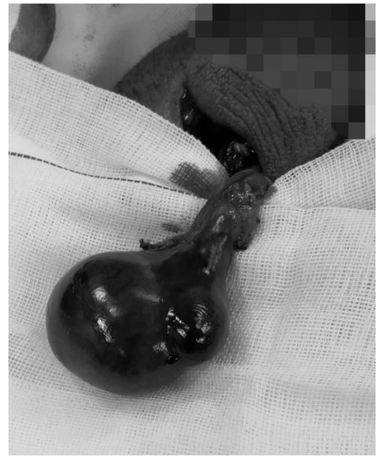 睾丸复位后观察15分钟仍无缓解,证实睾丸坏死希望大家积极转发此文