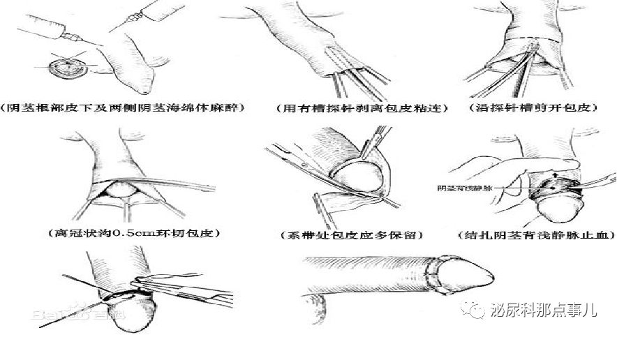 包茎手术套环流程图图片