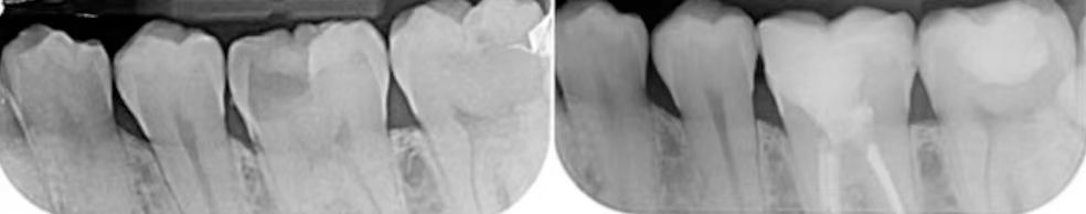 深边缘提升的再思考（龈壁提升的操作细节）