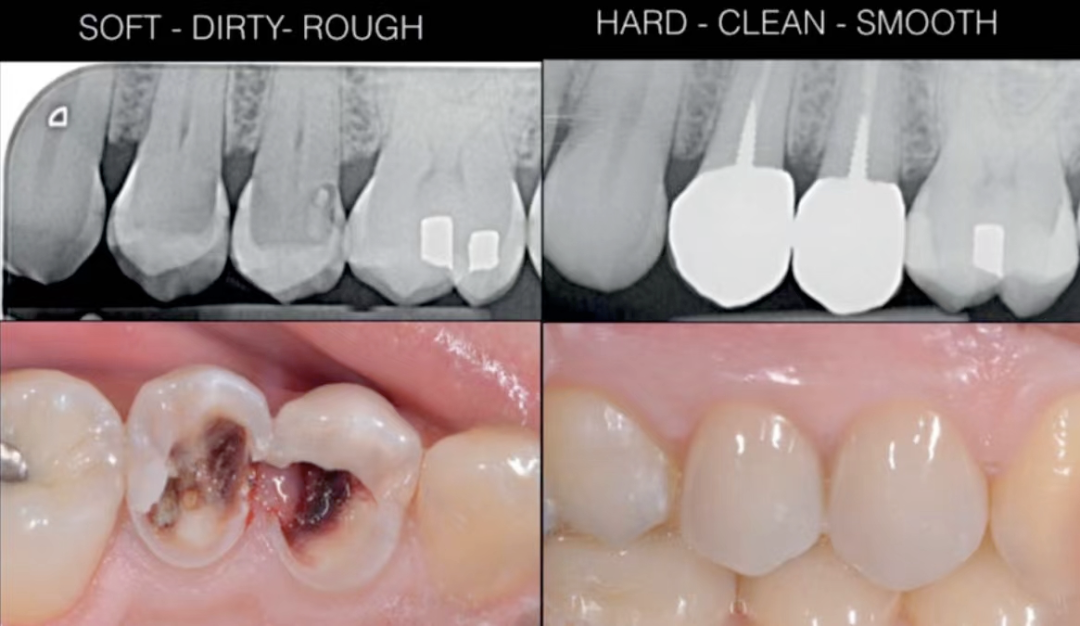 深边缘提升的再思考（龈壁提升的操作细节）