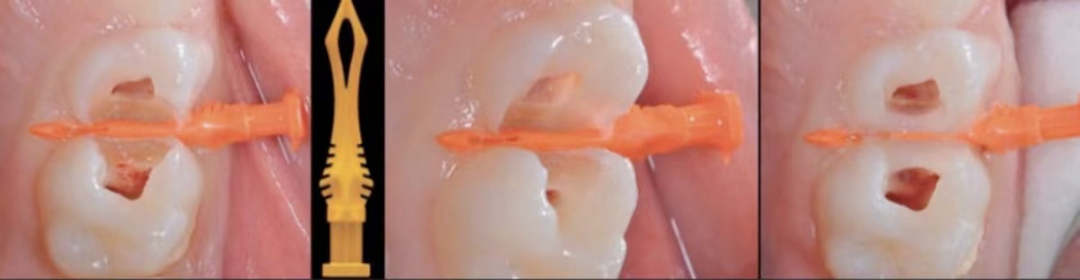 深边缘提升的再思考（龈壁提升的操作细节）