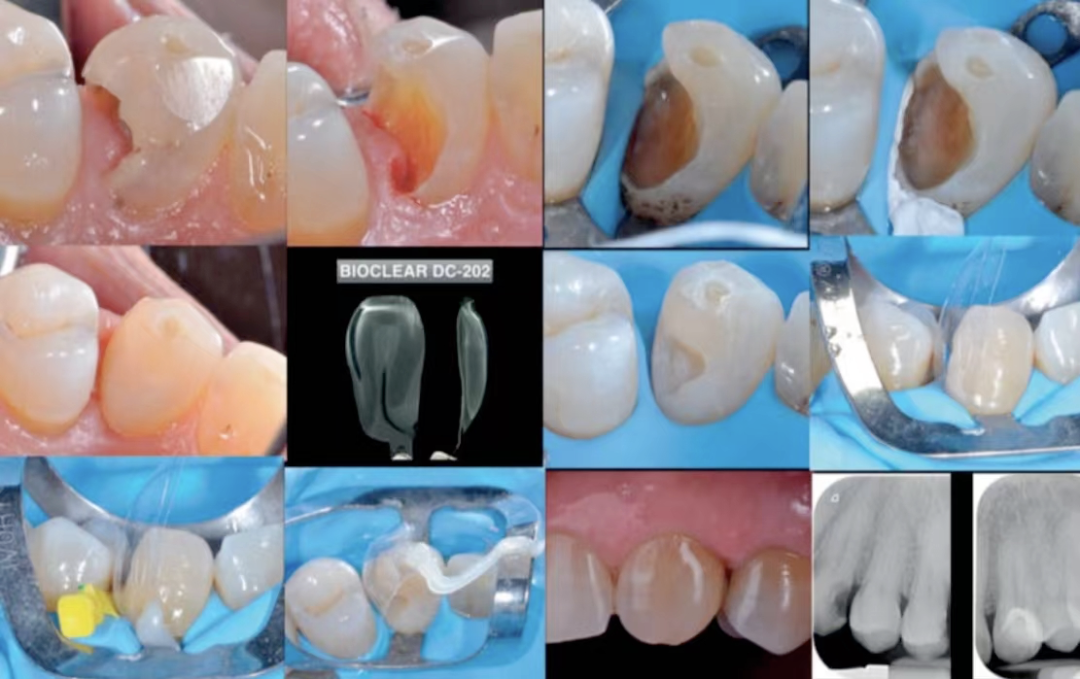 深边缘提升的再思考（龈壁提升的操作细节）