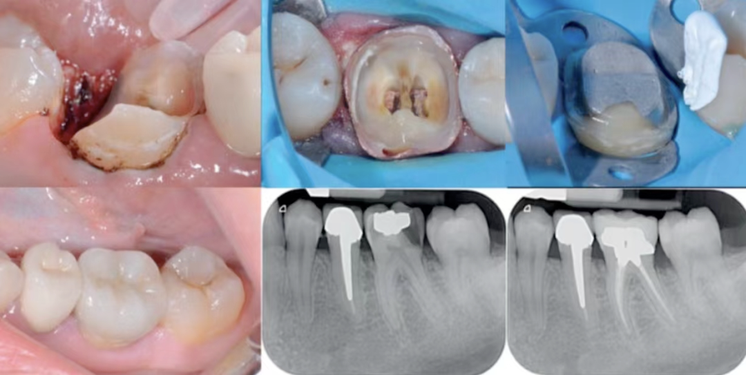 深边缘提升的再思考（龈壁提升的操作细节）