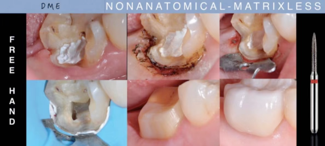 深边缘提升的再思考（龈壁提升的操作细节）