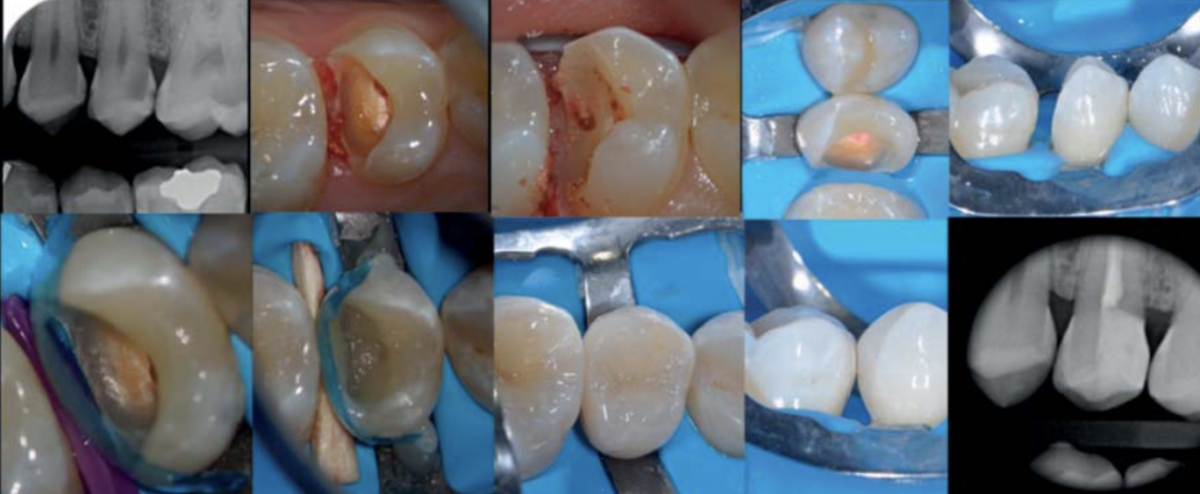 深边缘提升的再思考（龈壁提升的操作细节）