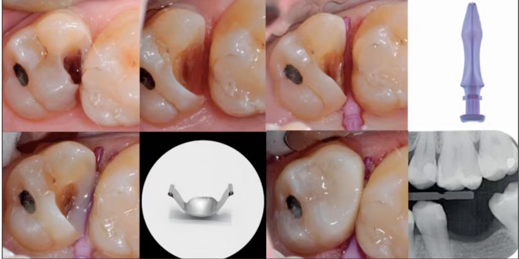 深边缘提升的再思考（龈壁提升的操作细节）