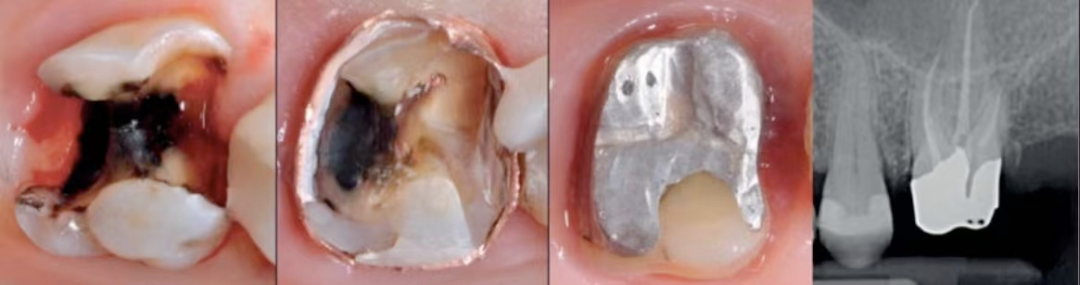 深边缘提升的再思考（龈壁提升的操作细节）