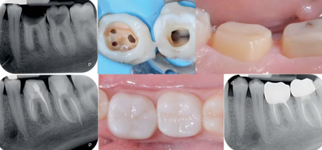 深边缘提升的再思考（龈壁提升的操作细节）