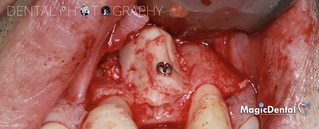 使用自体骨块移植进行牙槽嵴增量: