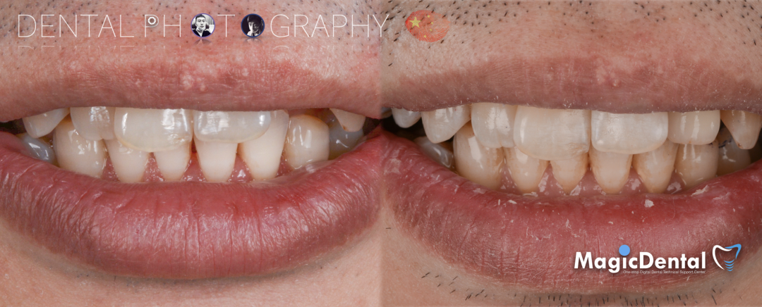 使用自体骨块移植进行牙槽嵴增量: