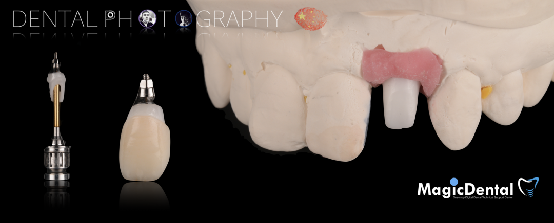 使用自体骨块移植进行牙槽嵴增量:
