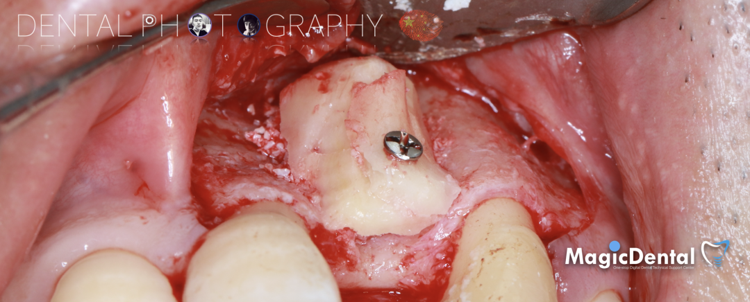 使用自体骨块移植进行牙槽嵴增量: