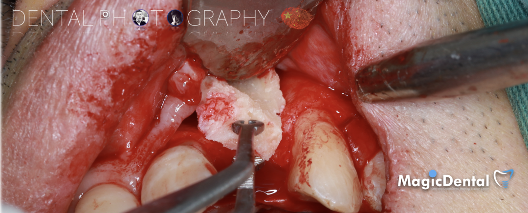 使用自体骨块移植进行牙槽嵴增量: