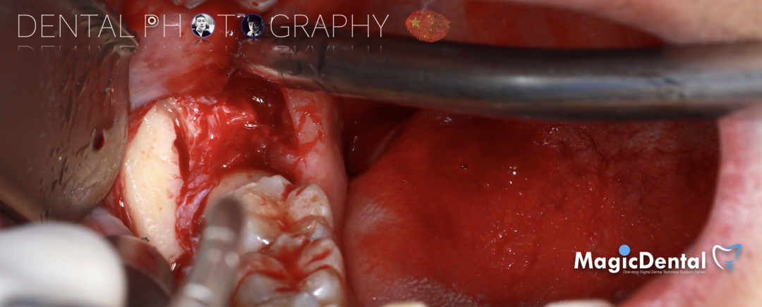 使用自体骨块移植进行牙槽嵴增量: