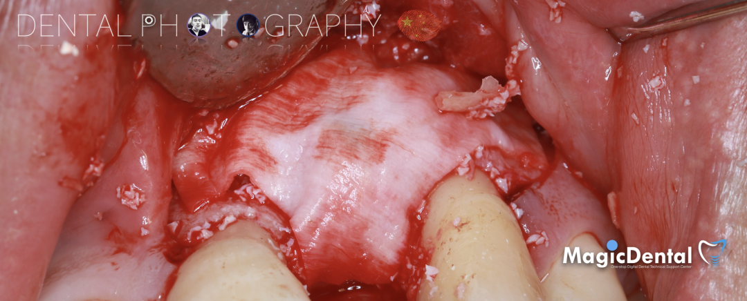 使用自体骨块移植进行牙槽嵴增量: