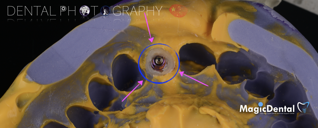 使用自体骨块移植进行牙槽嵴增量:
