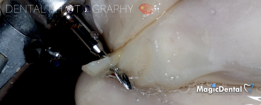 使用自体骨块移植进行牙槽嵴增量: