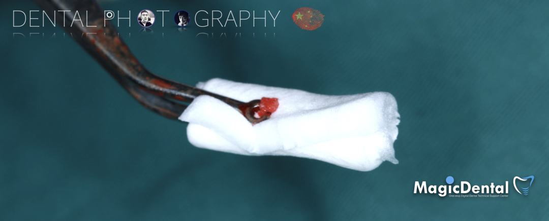 使用自体骨块移植进行牙槽嵴增量: