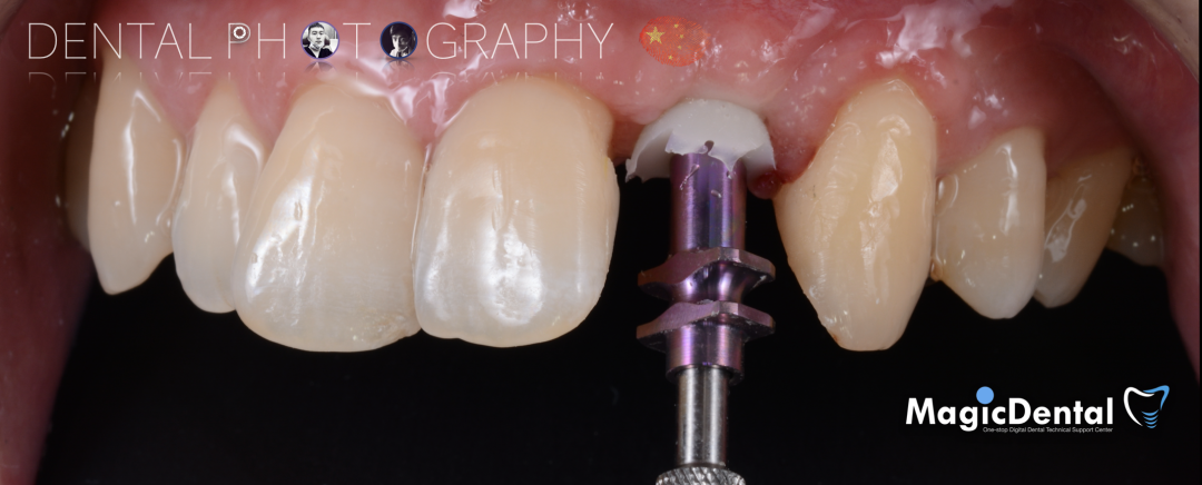 使用自体骨块移植进行牙槽嵴增量: