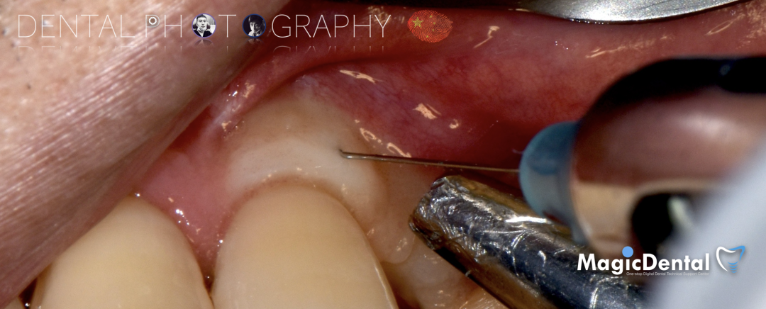 使用自体骨块移植进行牙槽嵴增量: