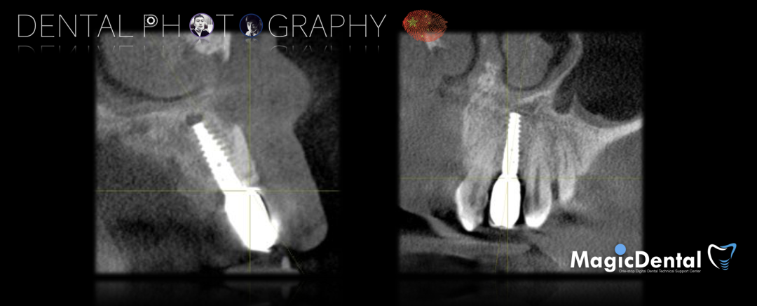 使用自体骨块移植进行牙槽嵴增量: