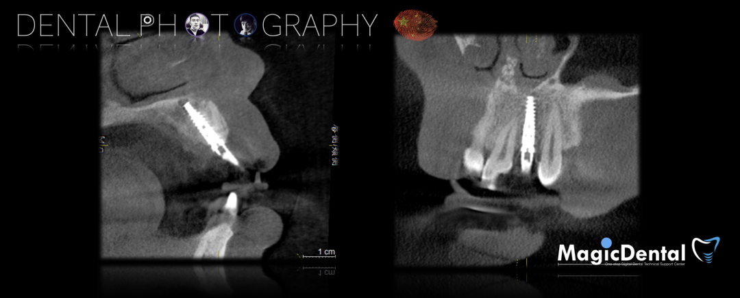 使用自体骨块移植进行牙槽嵴增量: