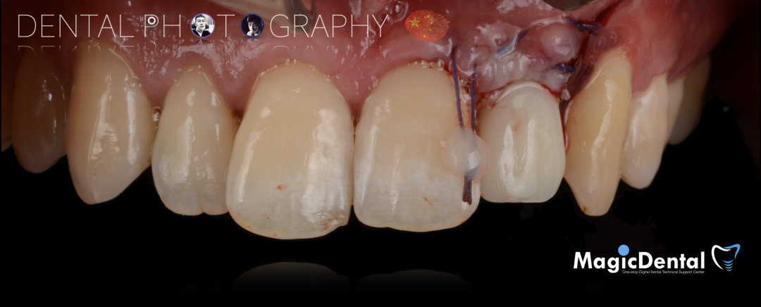 使用自体骨块移植进行牙槽嵴增量: