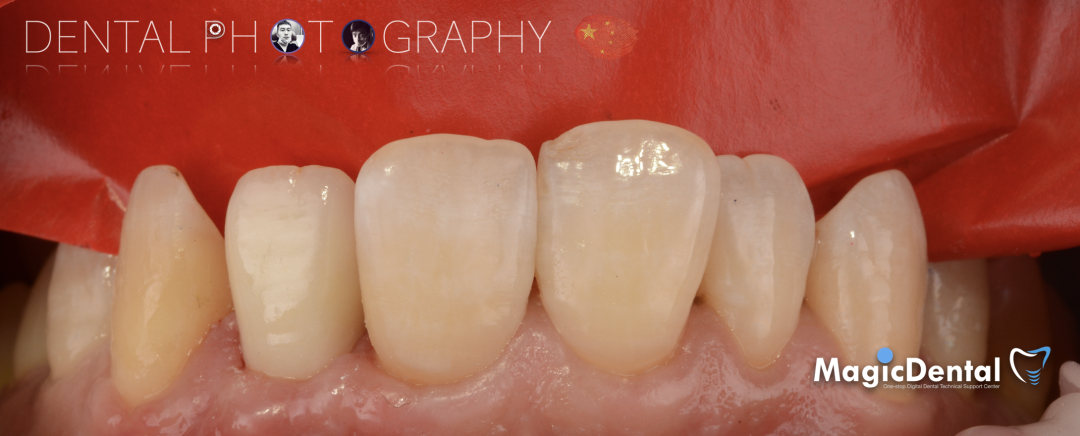 使用自体骨块移植进行牙槽嵴增量: