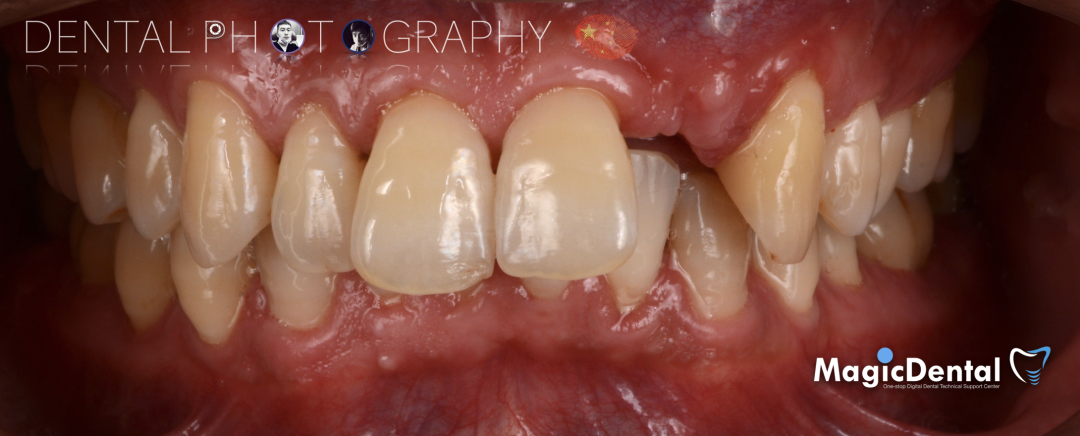 使用自体骨块移植进行牙槽嵴增量: