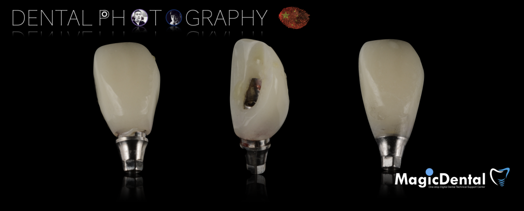 使用自体骨块移植进行牙槽嵴增量: