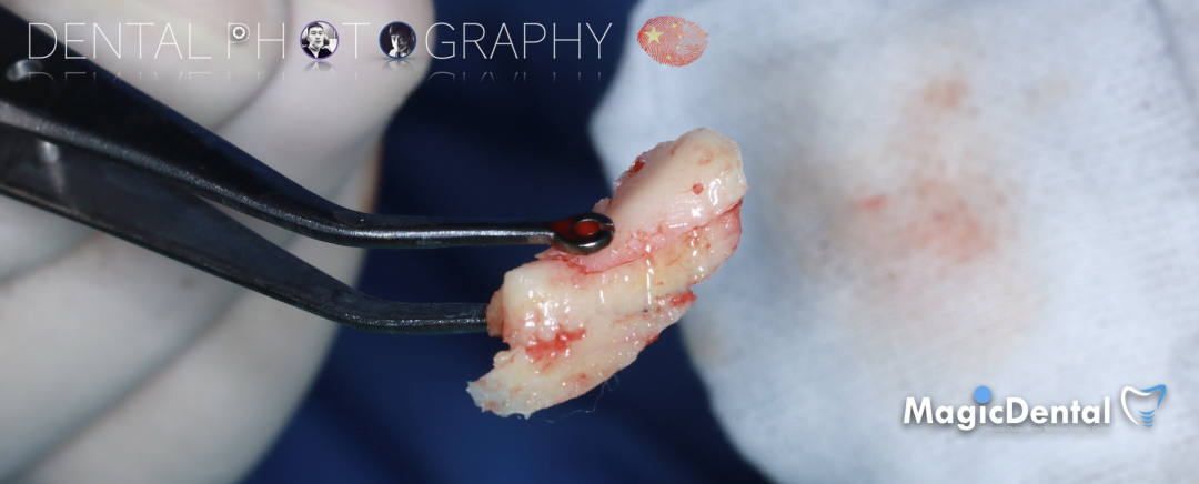 使用自体骨块移植进行牙槽嵴增量: