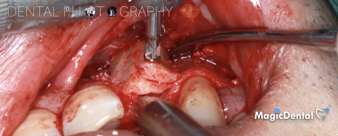 使用自体骨块移植进行牙槽嵴增量: