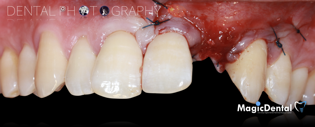 使用自体骨块移植进行牙槽嵴增量: