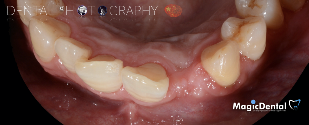 使用自体骨块移植进行牙槽嵴增量: