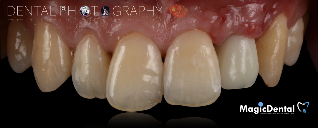 使用自体骨块移植进行牙槽嵴增量:
