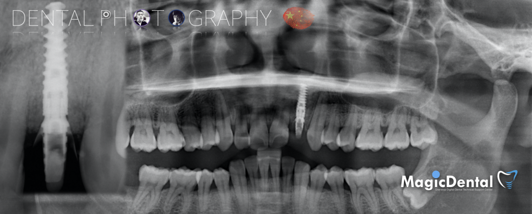 使用自体骨块移植进行牙槽嵴增量: