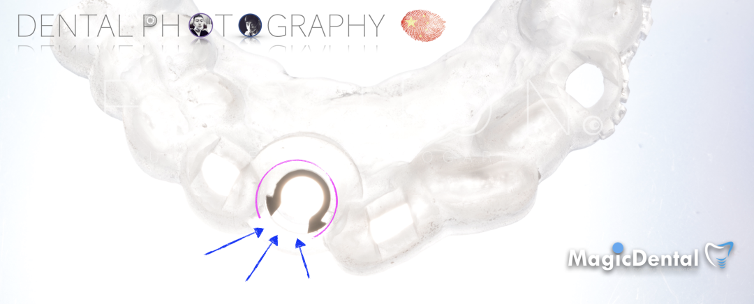 使用自体骨块移植进行牙槽嵴增量: