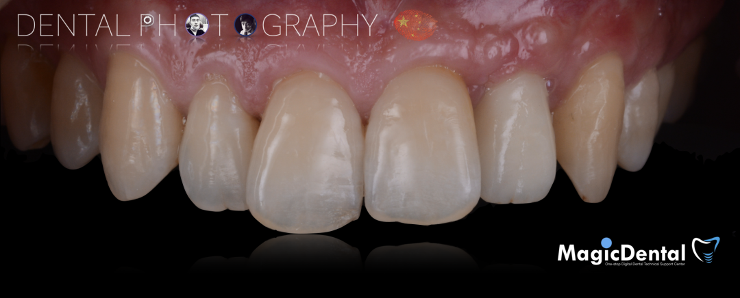 使用自体骨块移植进行牙槽嵴增量: