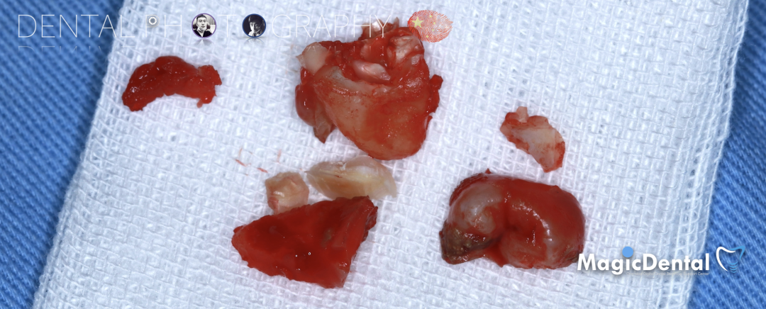 使用自体骨块移植进行牙槽嵴增量: