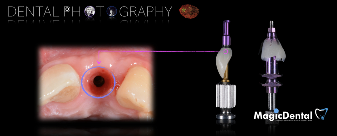 使用自体骨块移植进行牙槽嵴增量: