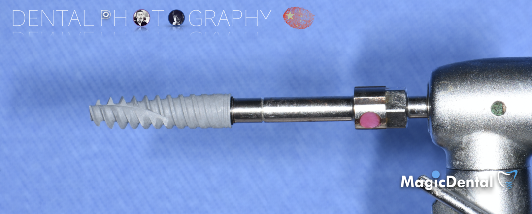 使用自体骨块移植进行牙槽嵴增量: